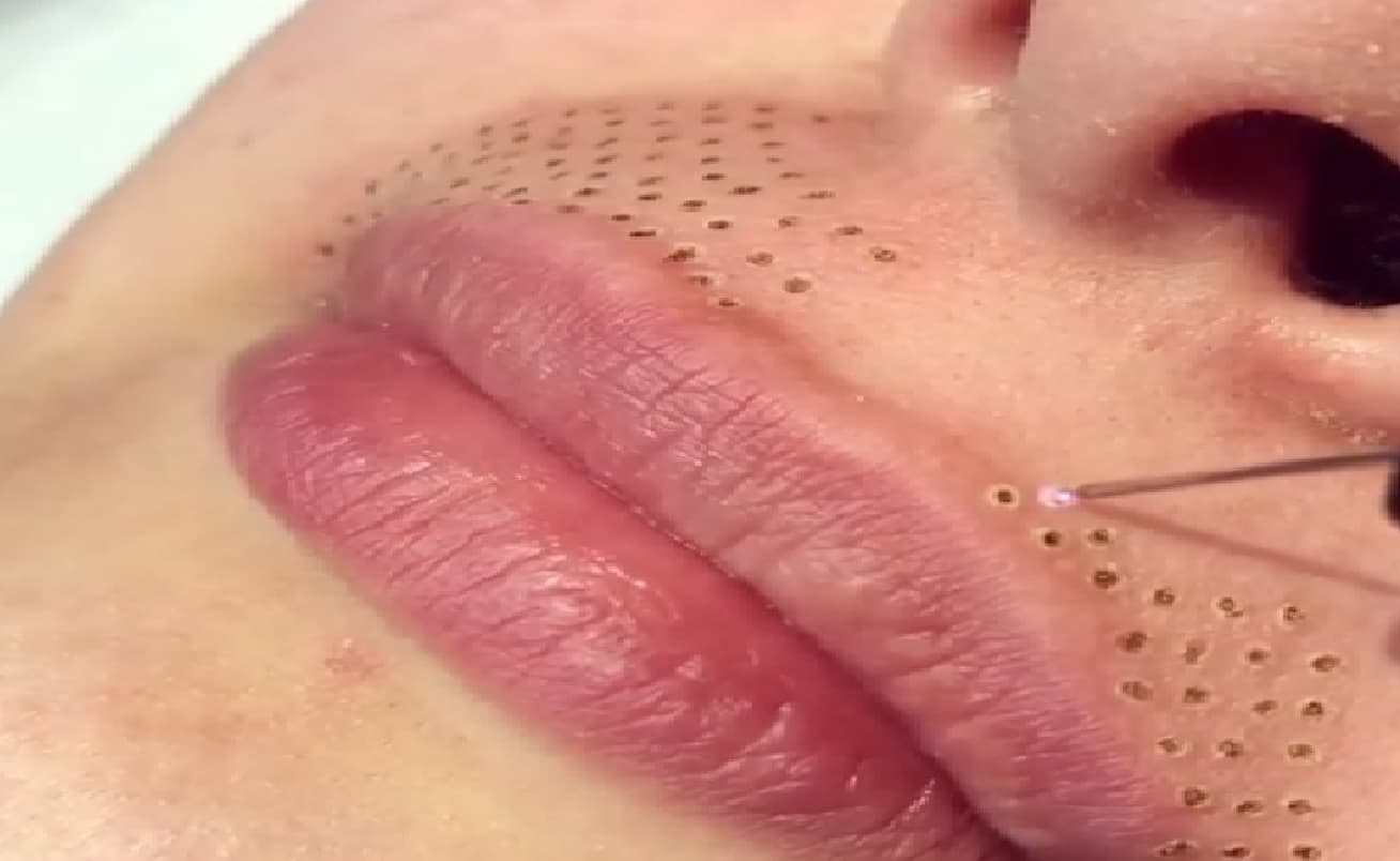 Plasma IQ, el tratamiento de belleza que quema tu piel para rejuvenecer