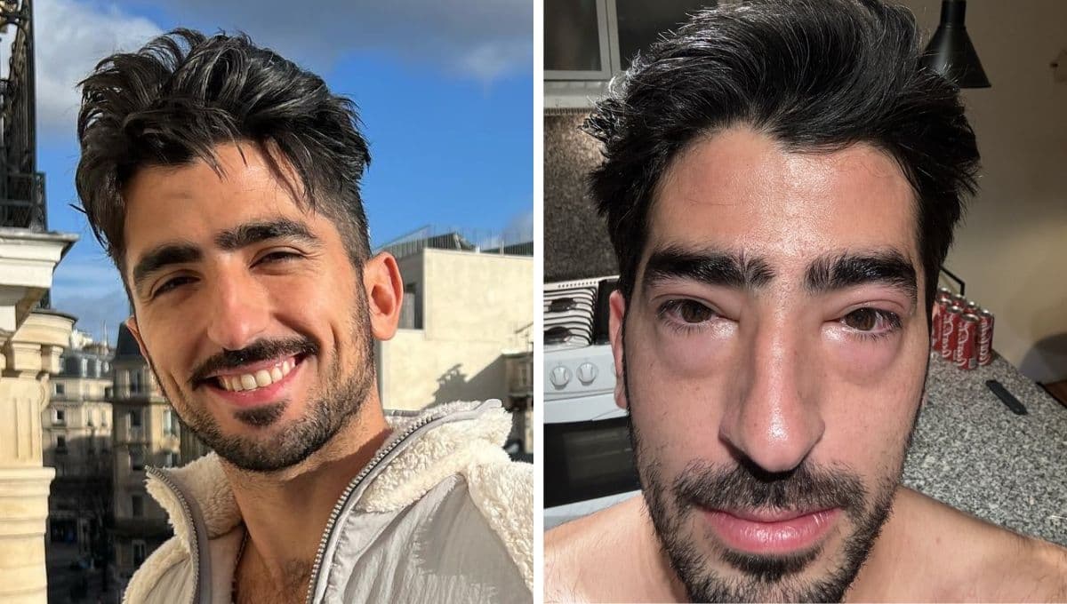 ¿Qué le pasó a Jezzini? El influencer aparece con los ojos hinchados