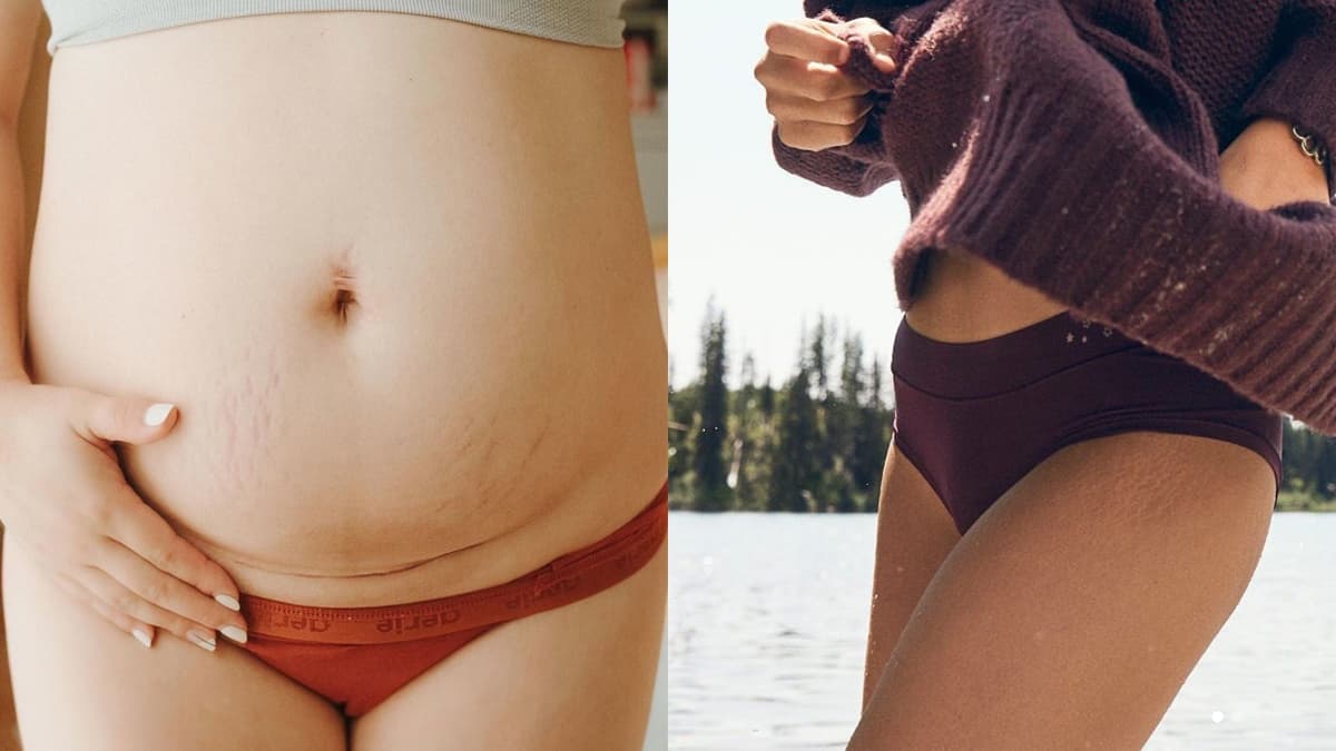 6 tratamientos caseros para prevenir y desaparecer estrías